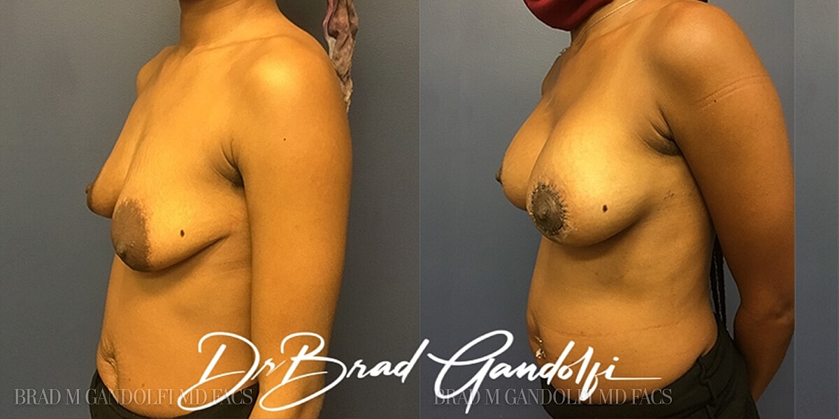 Breast Lift Before & After