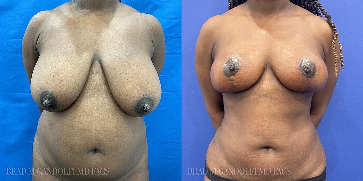 Breast Lift Before & After