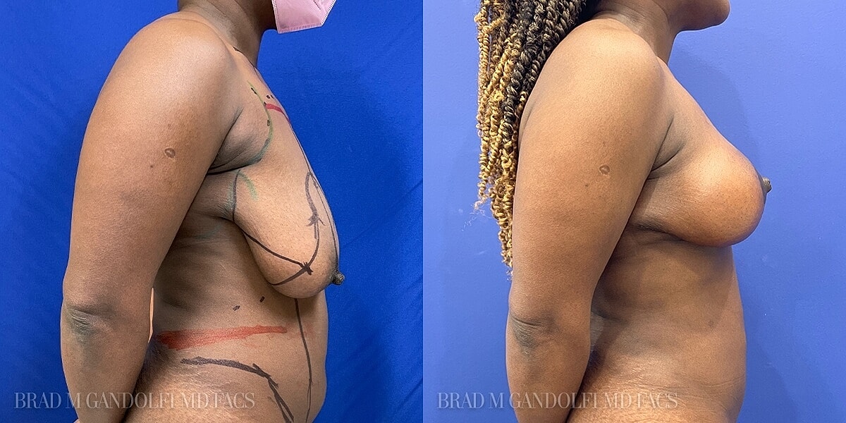 Breast Lift Before & After