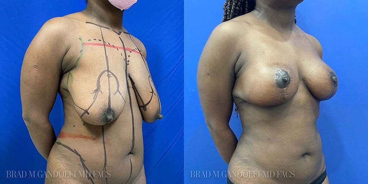 Breast Lift Before & After