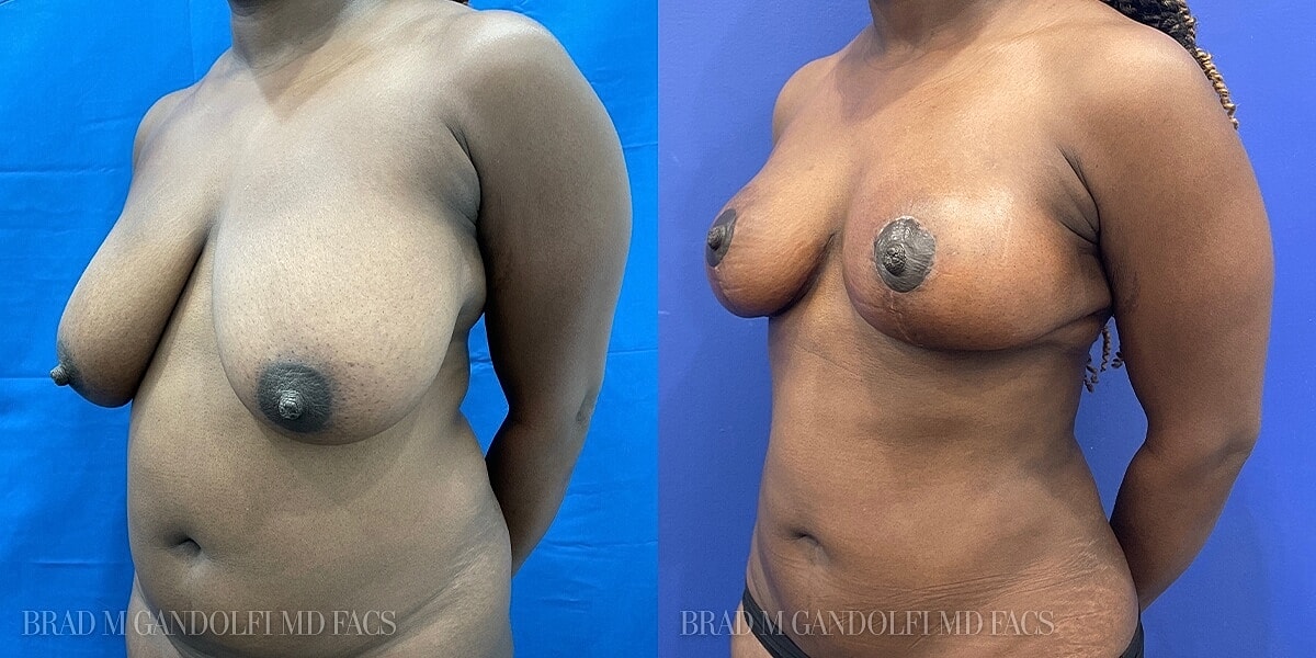 Breast Lift Before & After