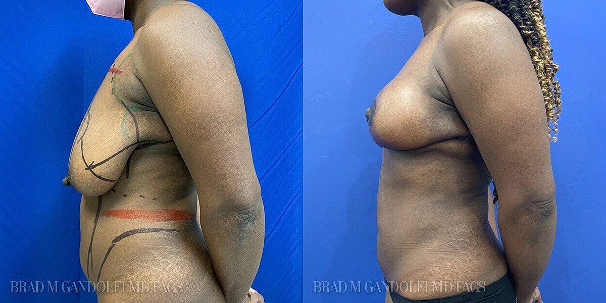 Breast Lift Before & After