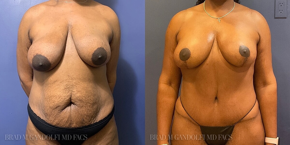 Breast Lift Before & After