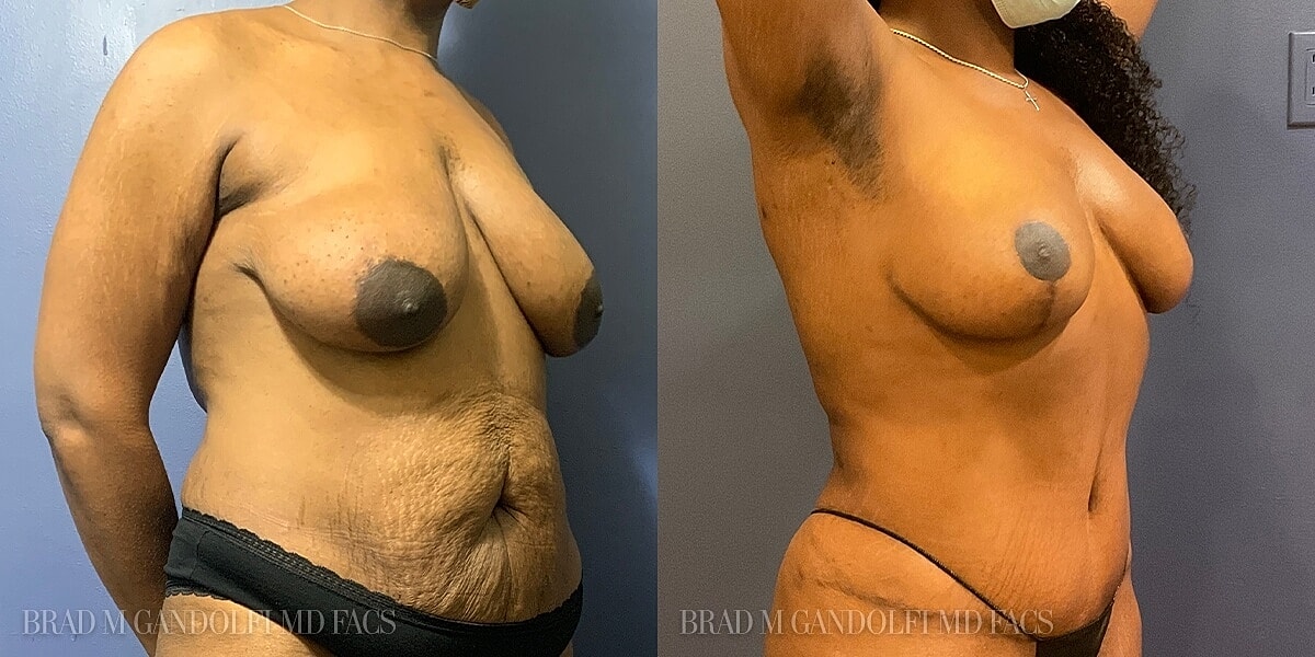Breast Lift Before & After