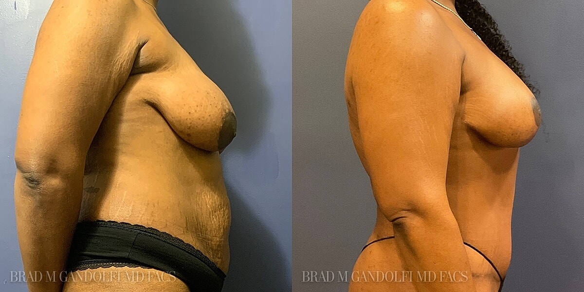 Breast Lift Before & After