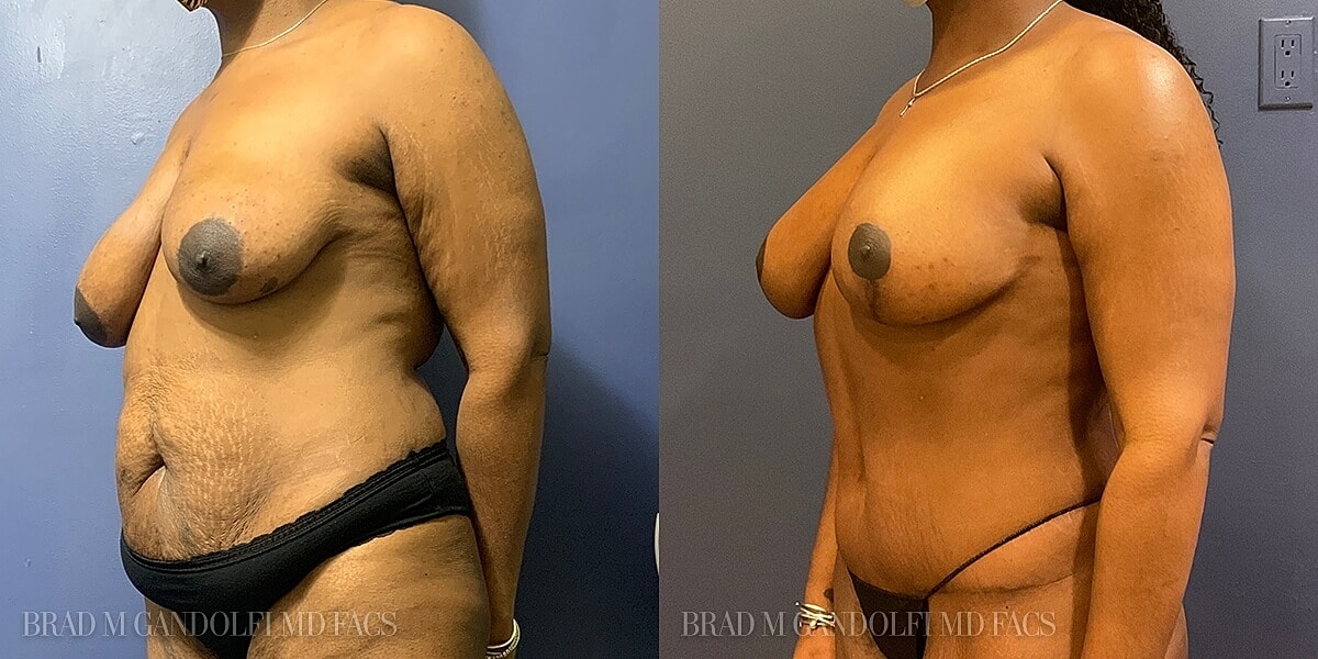 Breast Lift Before & After