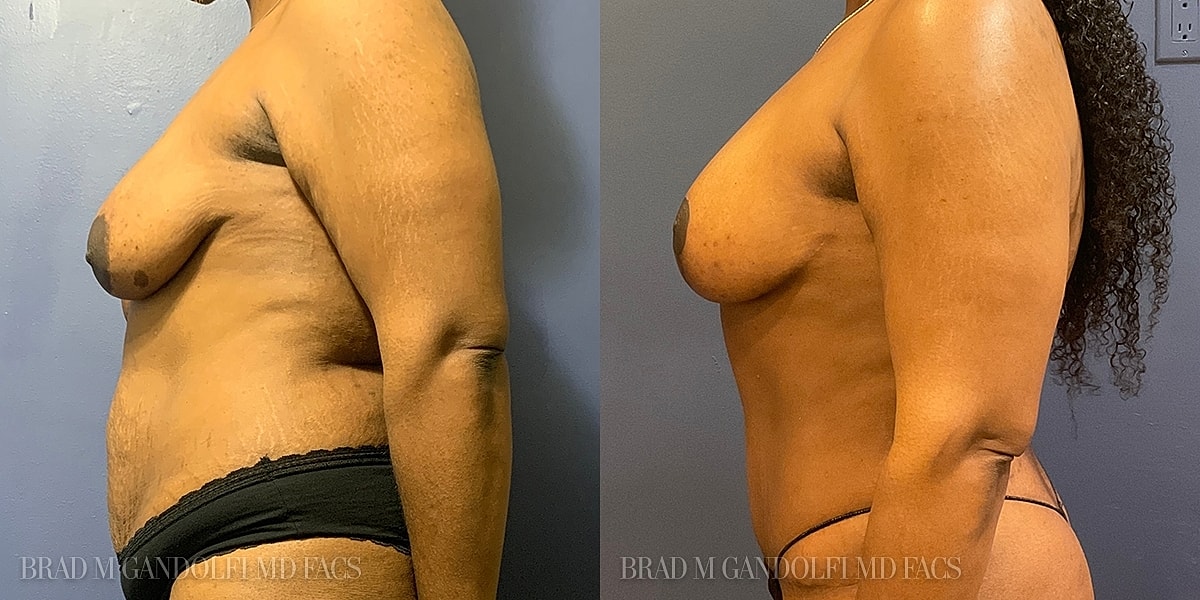 Breast Lift Before & After