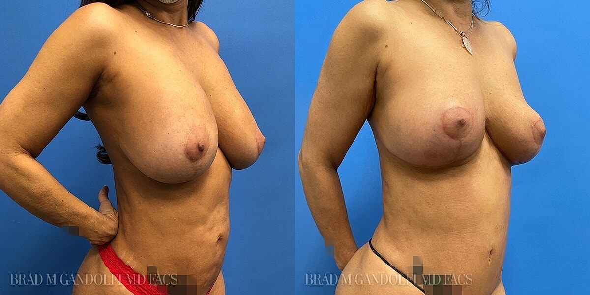 Breast Lift Before & After