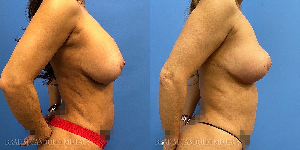 Breast Lift Before & After