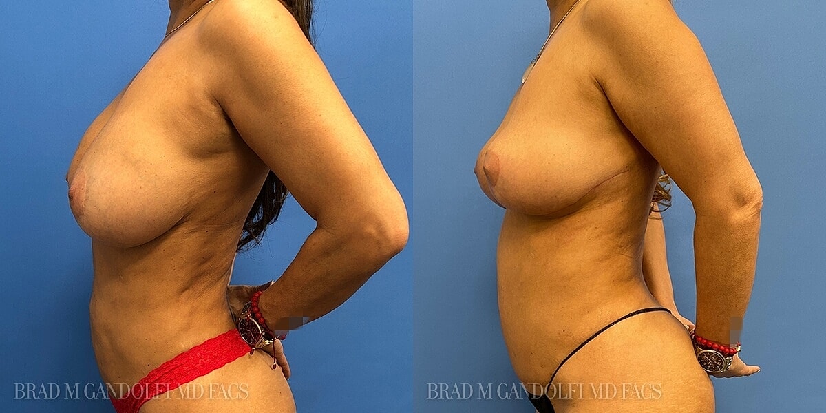Breast Lift Before & After