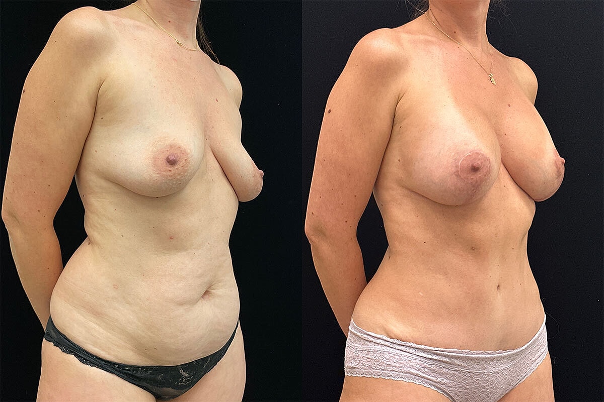 Breast Lift Before & After
