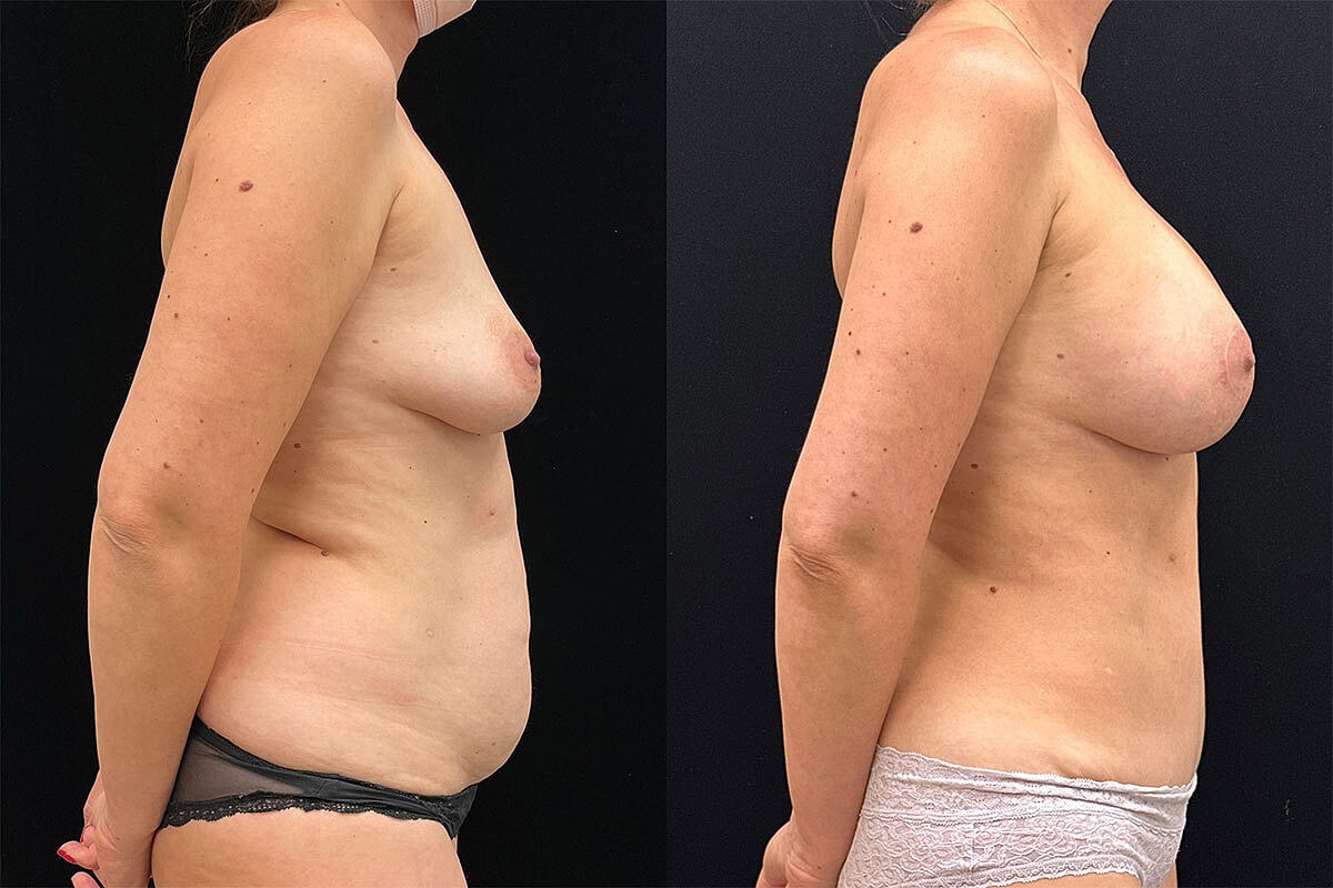Breast Lift Before & After