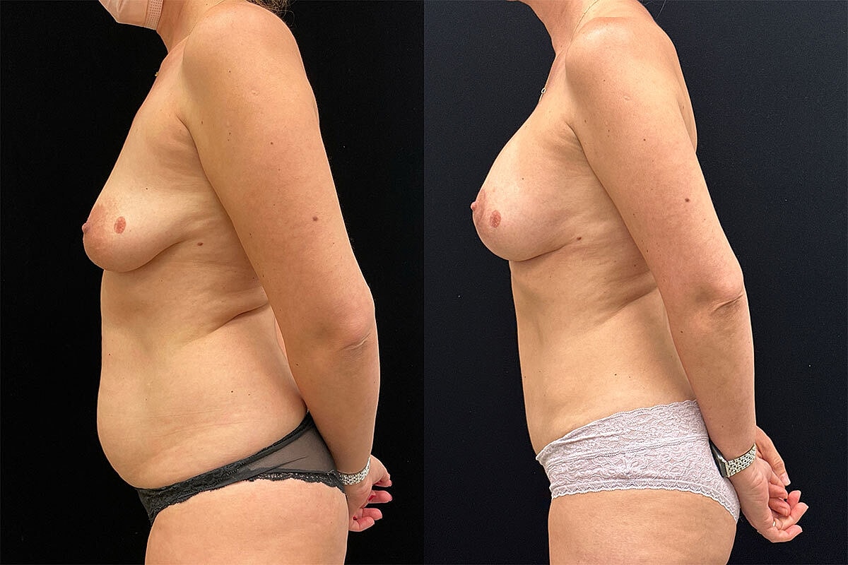 Breast Lift Before & After