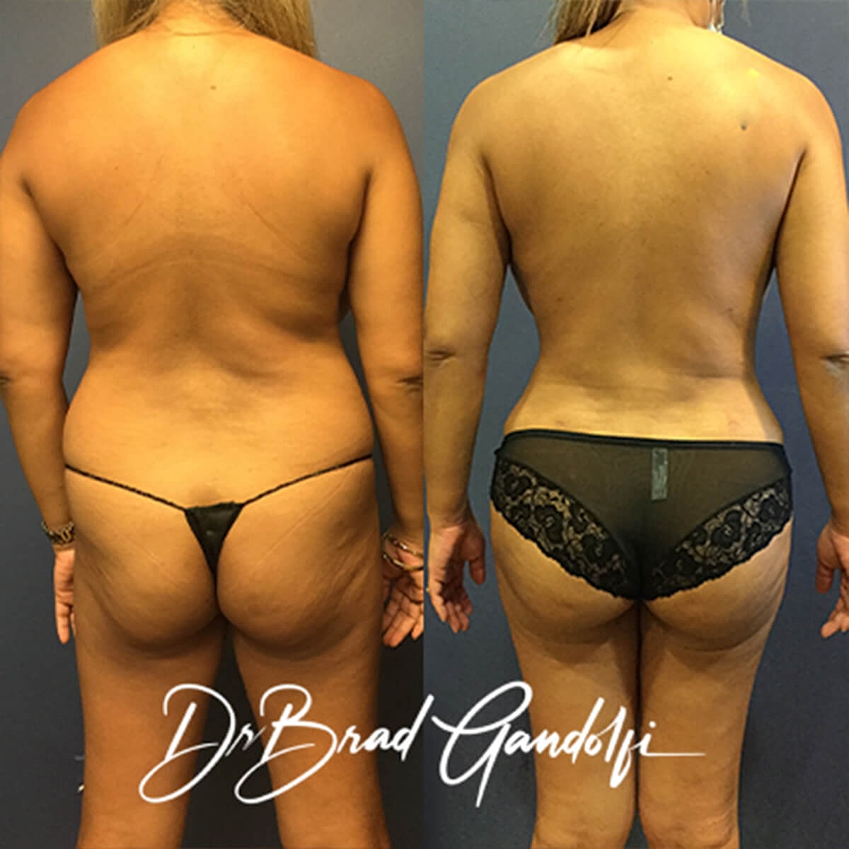 Brazilian Butt Lift Before & After