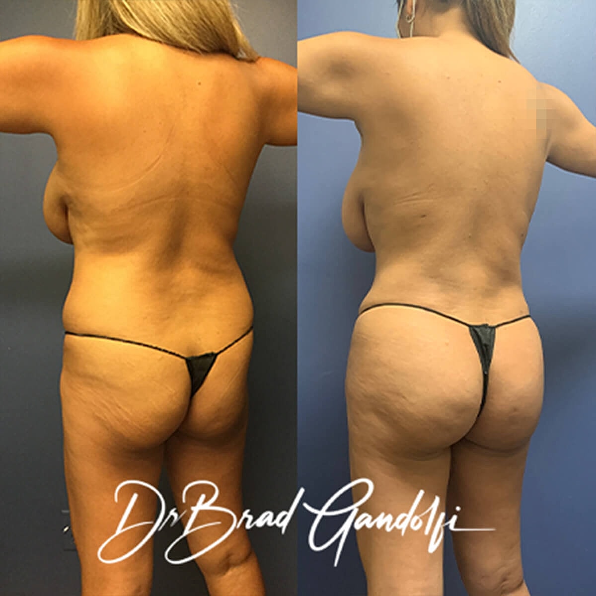 Brazilian Butt Lift Before & After