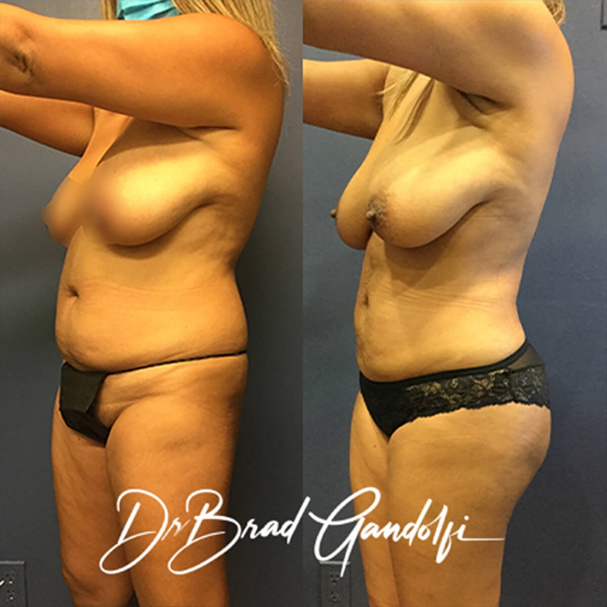 Brazilian Butt Lift Before & After