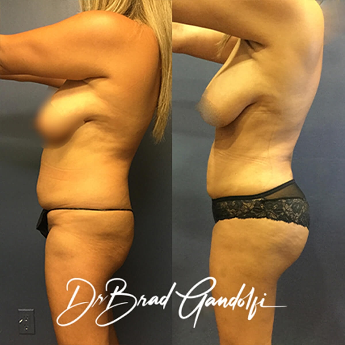Brazilian Butt Lift Before & After
