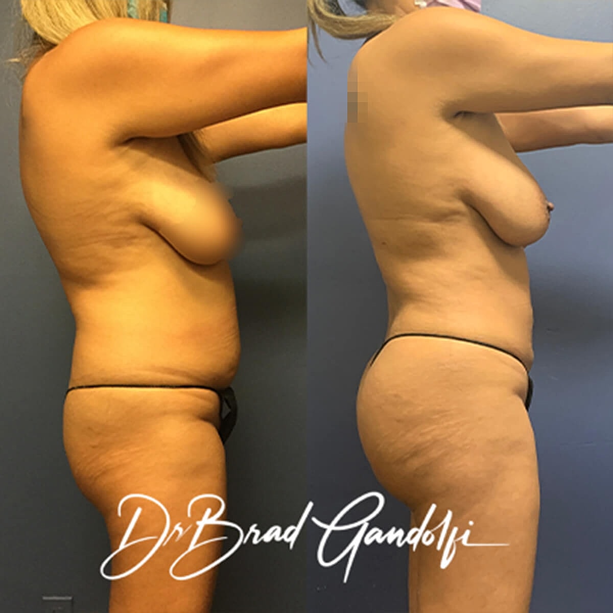 Brazilian Butt Lift Before & After