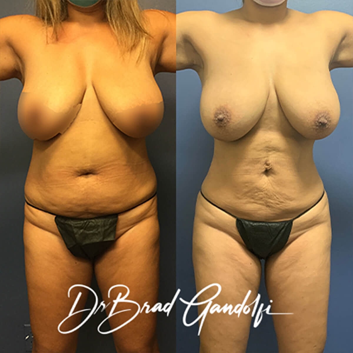 Brazilian Butt Lift Before & After