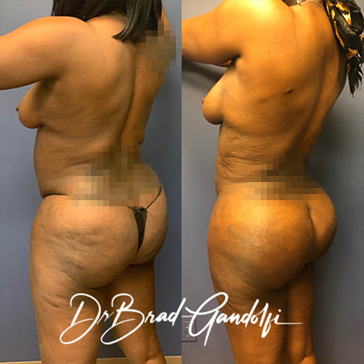 Brazilian Butt Lift Before & After