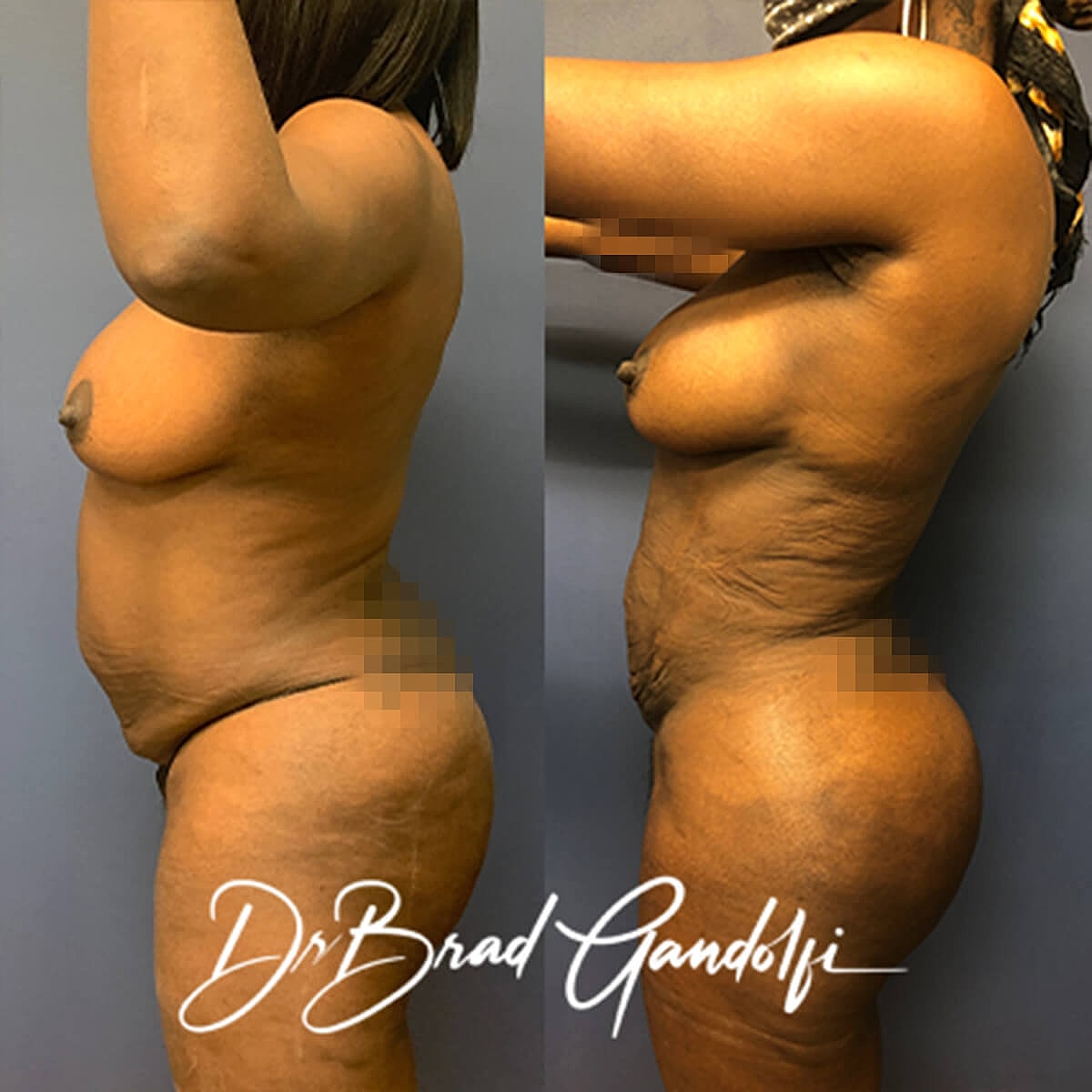 Brazilian Butt Lift Before & After