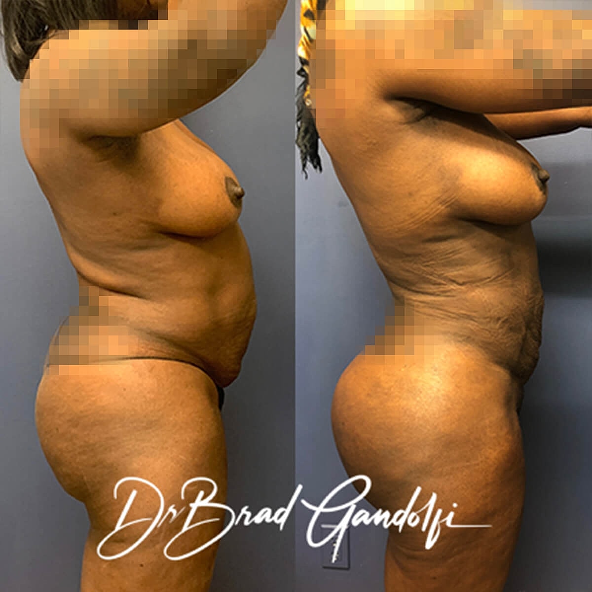 Brazilian Butt Lift Before & After