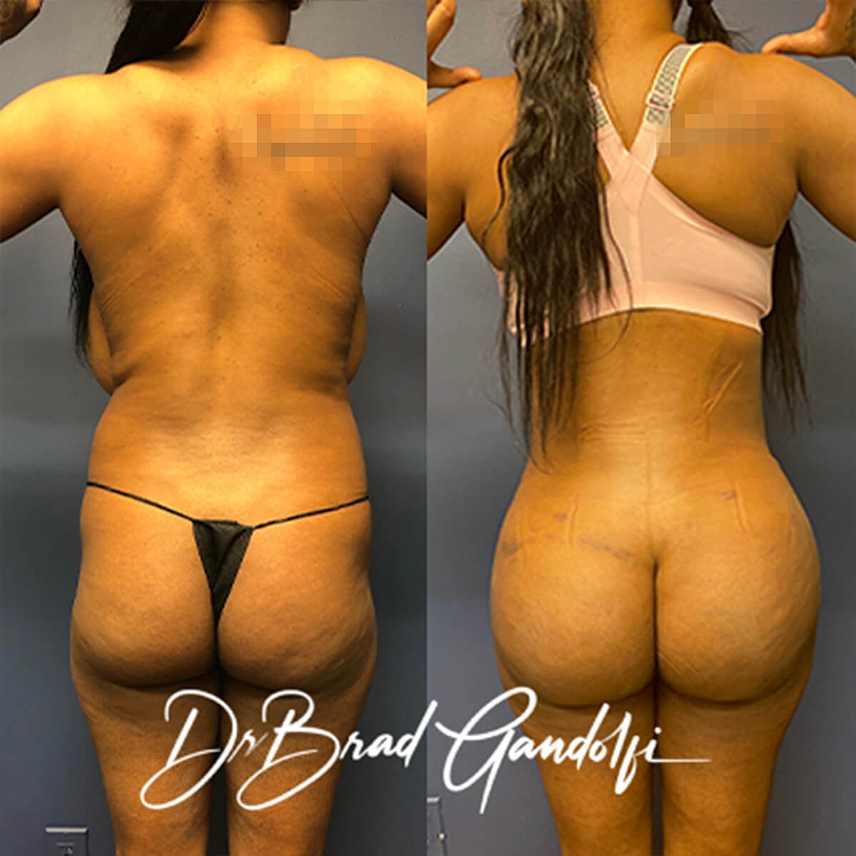 Brazilian Butt Lift Before & After