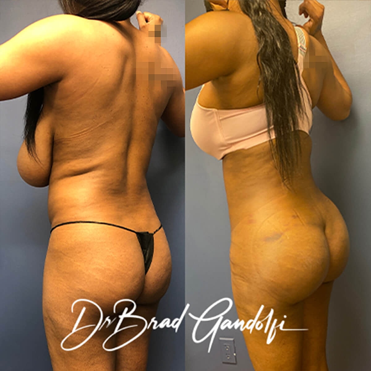 Brazilian Butt Lift Before & After