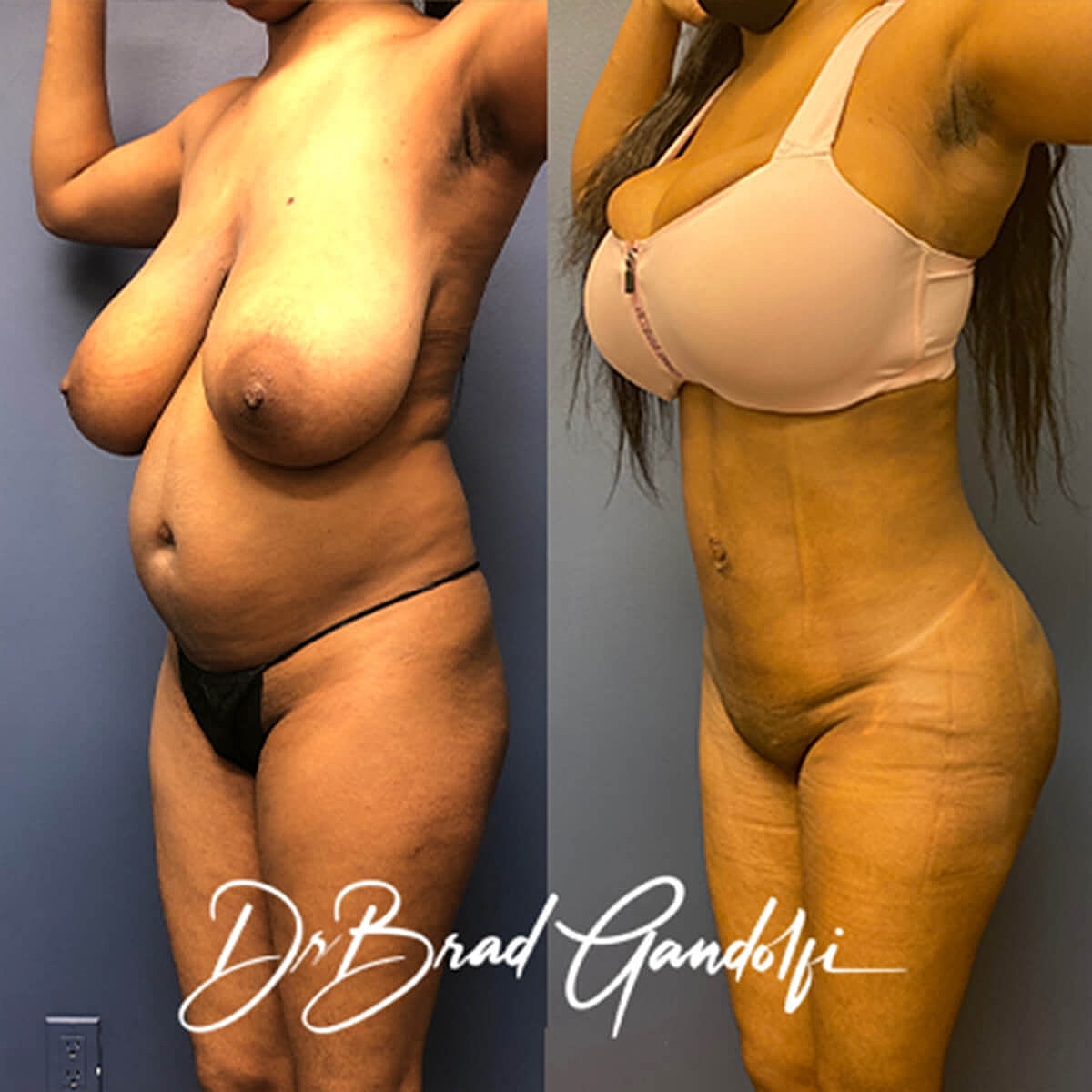 Brazilian Butt Lift Before & After