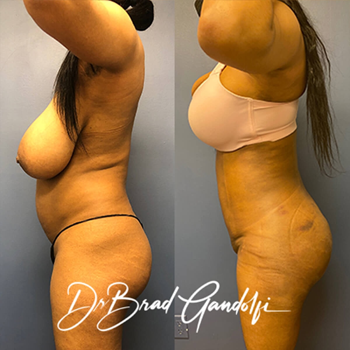 Brazilian Butt Lift Before & After
