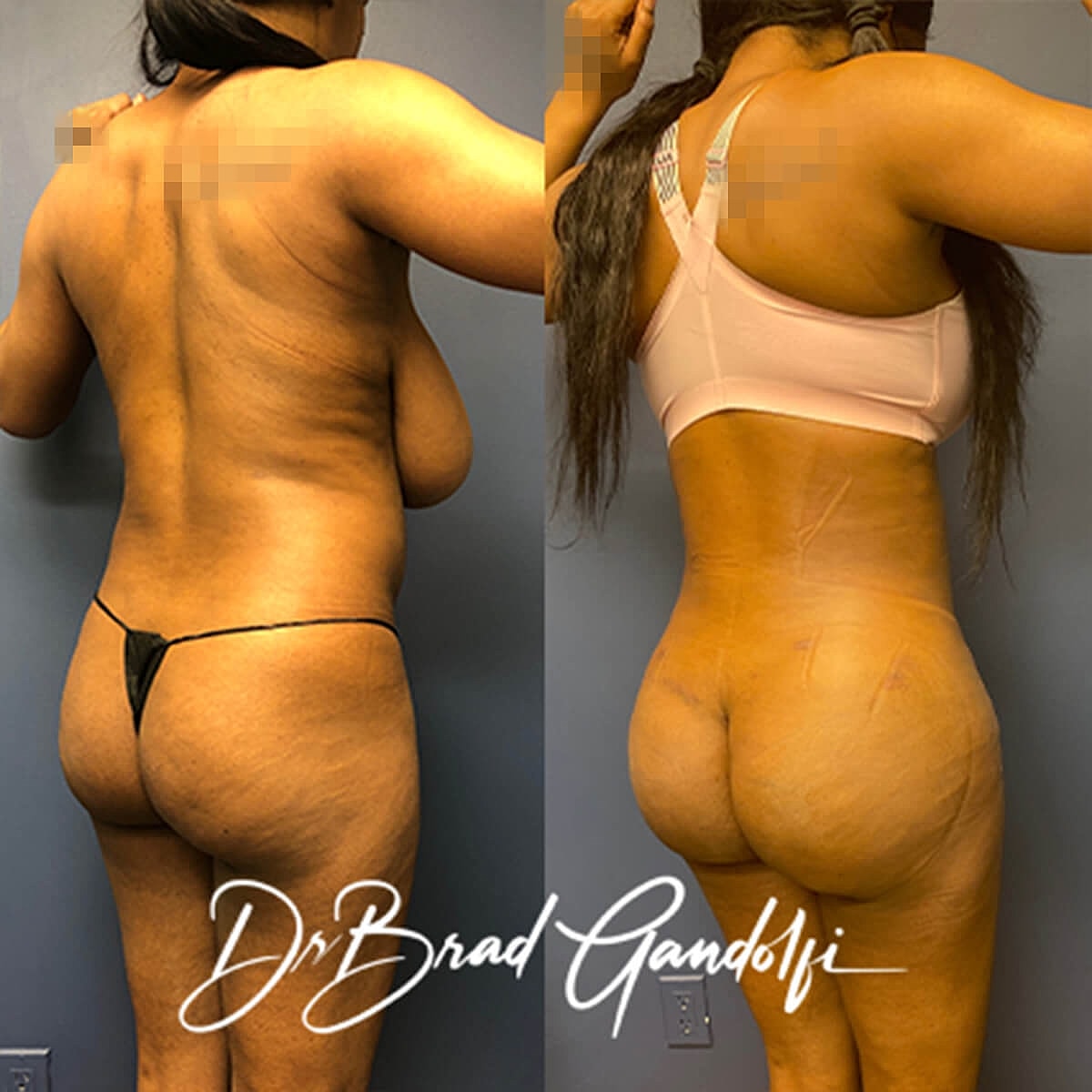 Brazilian Butt Lift Before & After