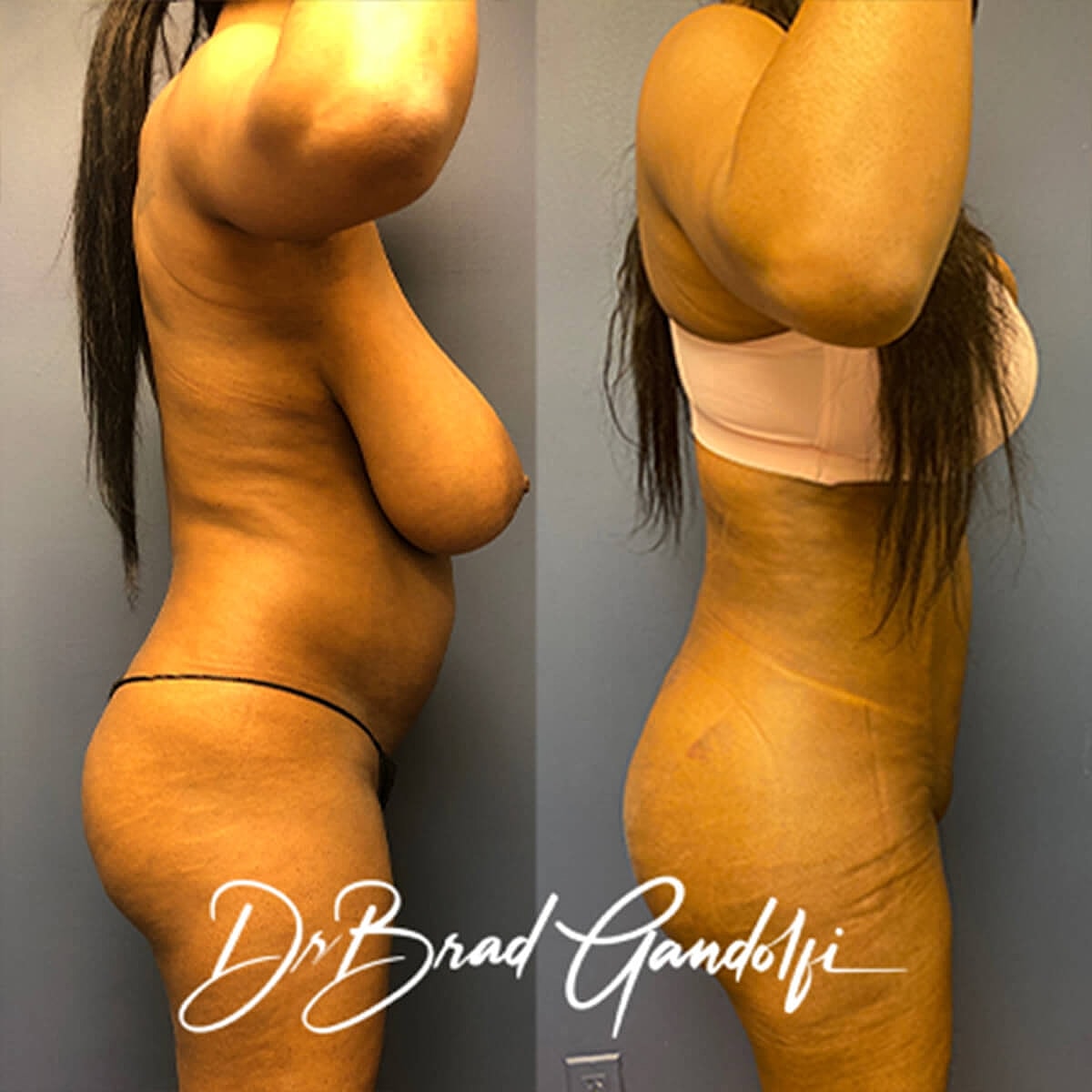 Brazilian Butt Lift Before & After