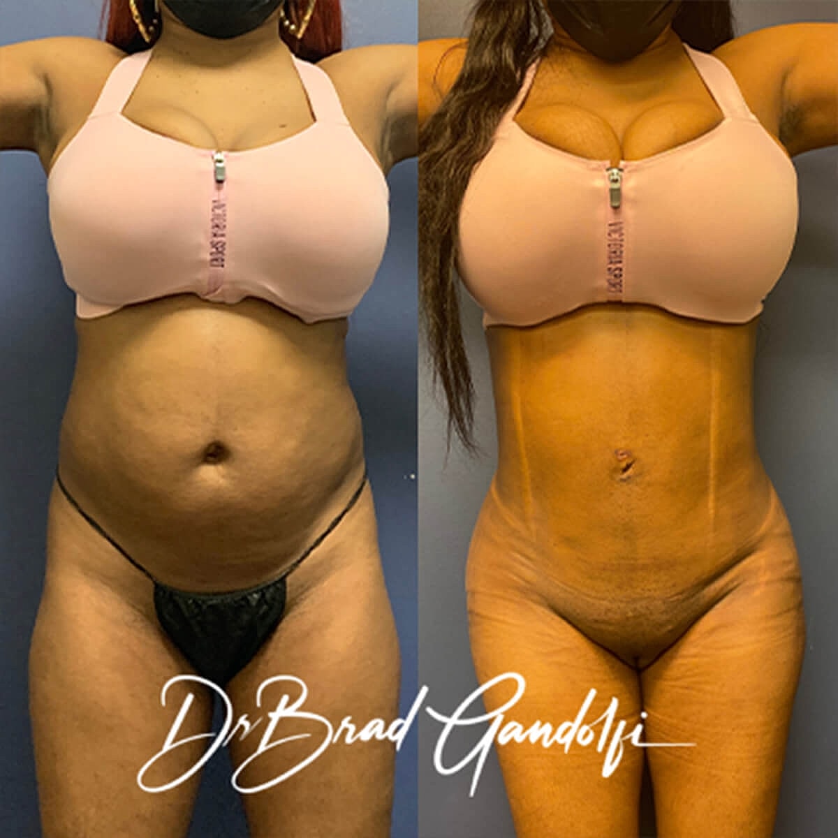 Brazilian Butt Lift Before & After