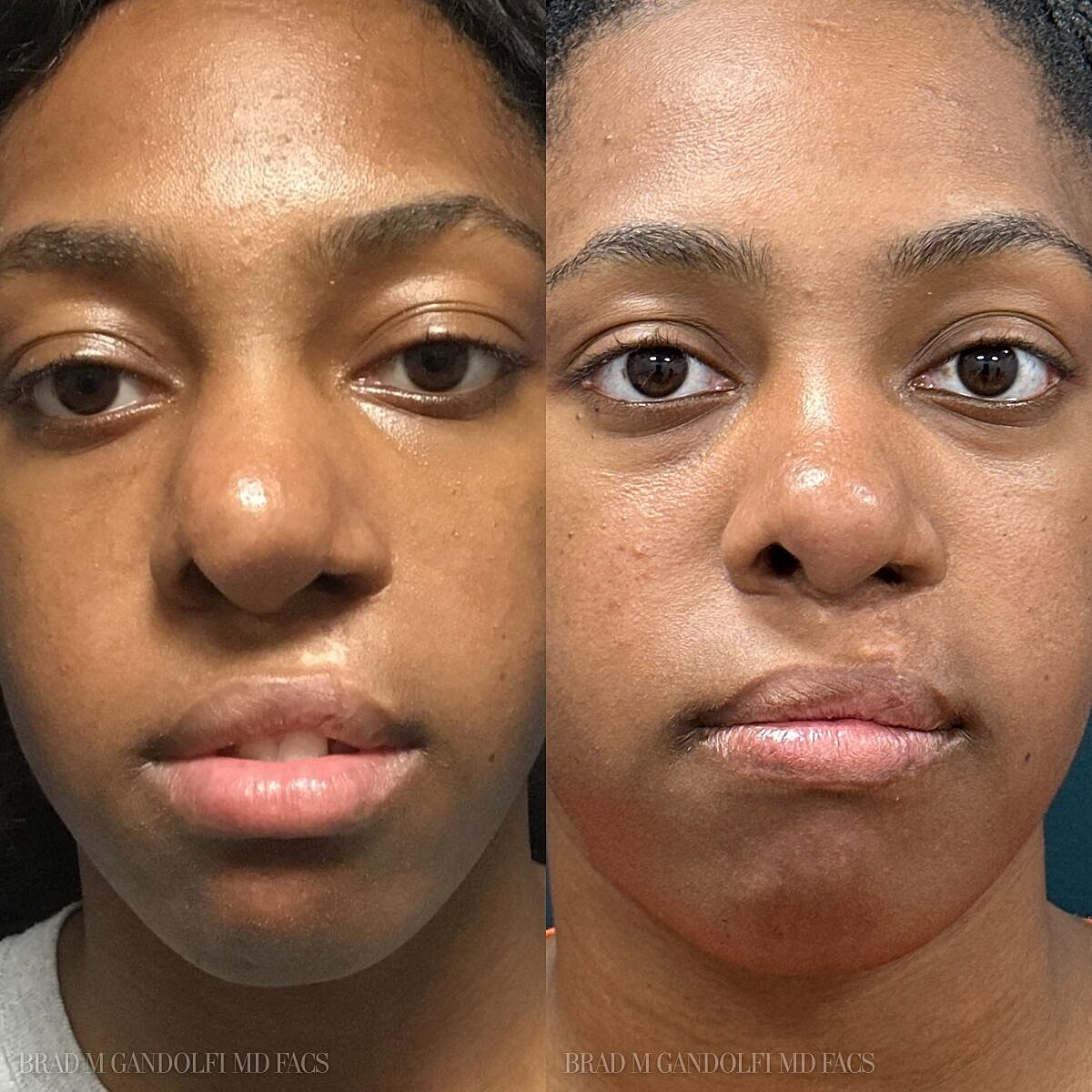 Rhinoplasty Before & After