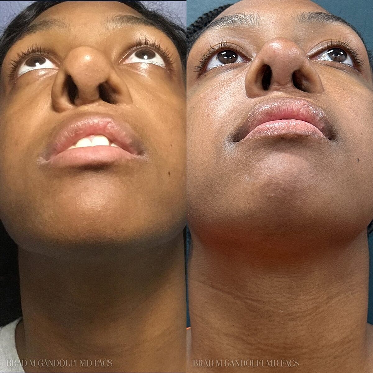 Rhinoplasty Before & After
