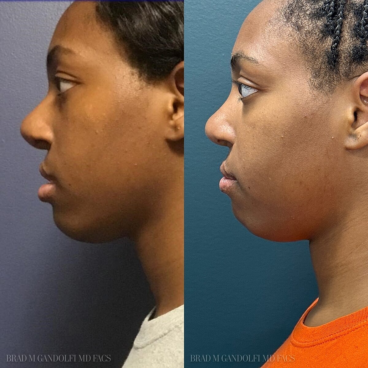 Rhinoplasty Before & After
