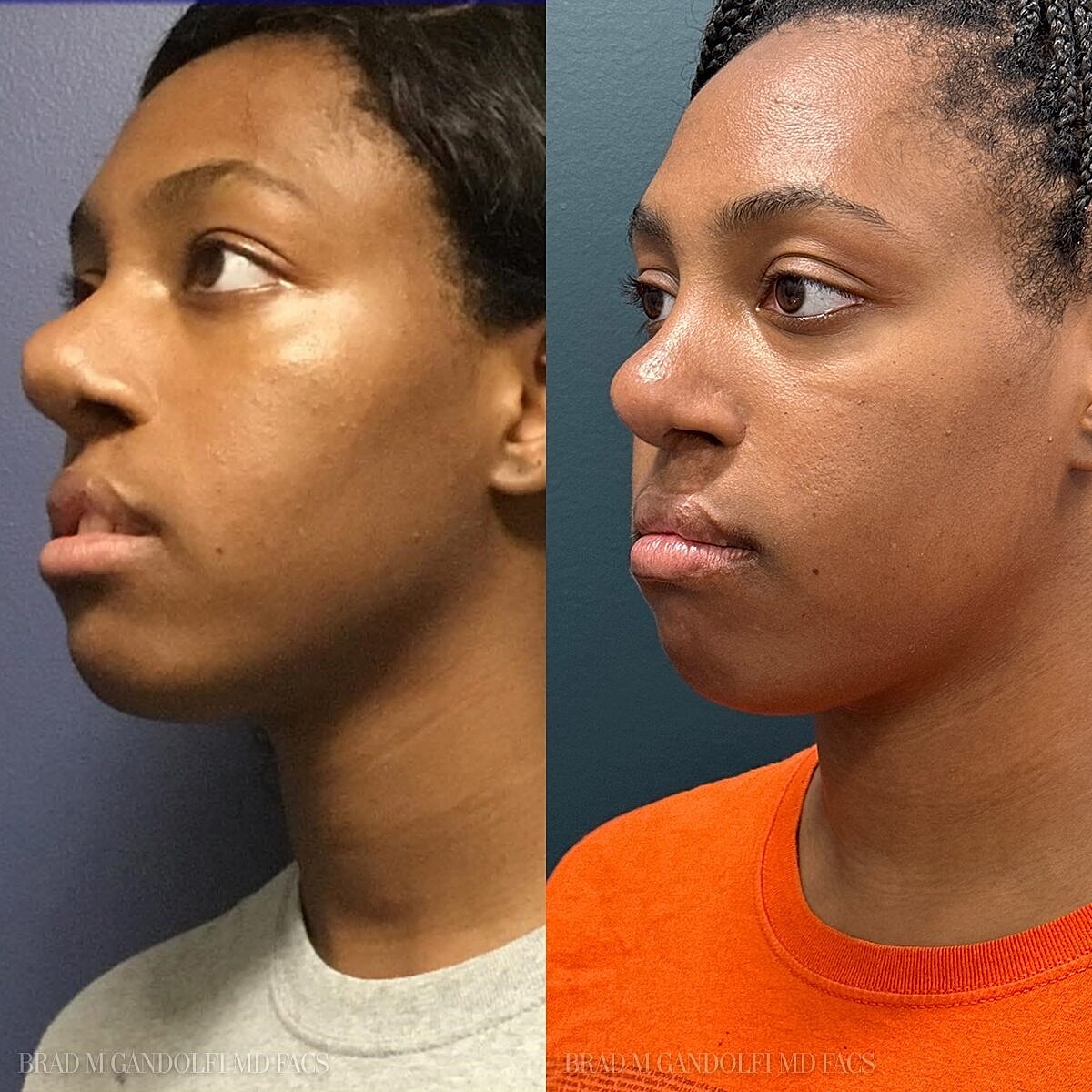 Rhinoplasty Before & After