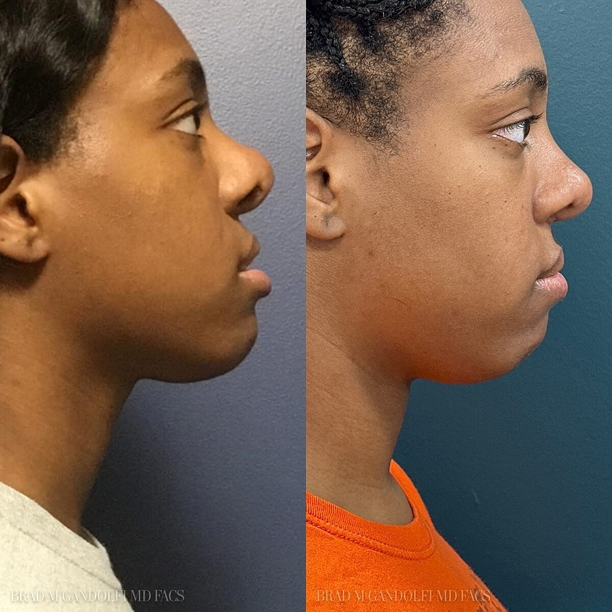 Rhinoplasty Before & After