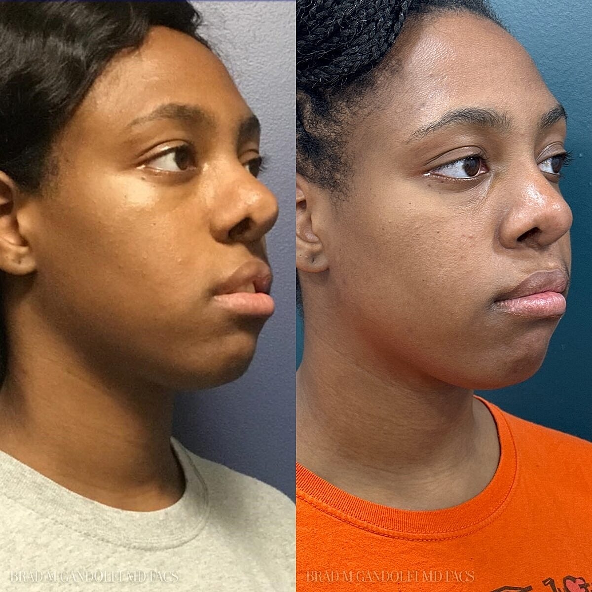 Rhinoplasty Before & After