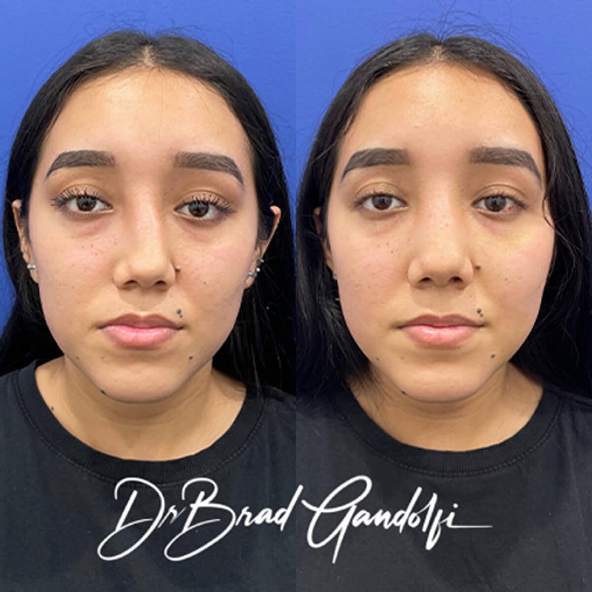 Rhinoplasty Before & After