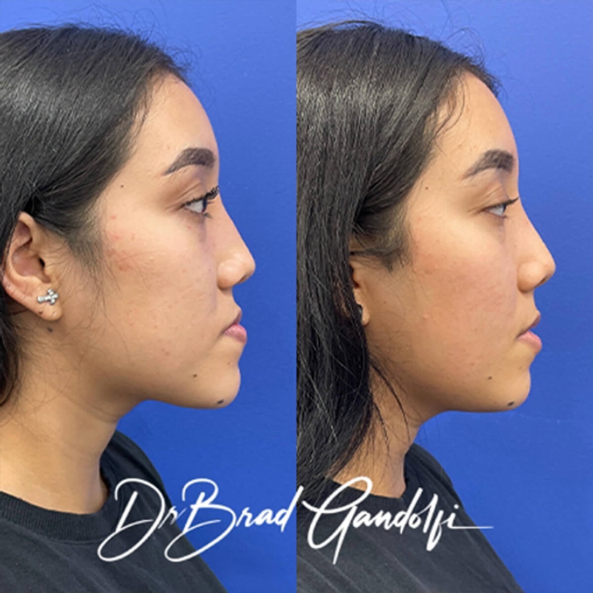 Rhinoplasty Before & After