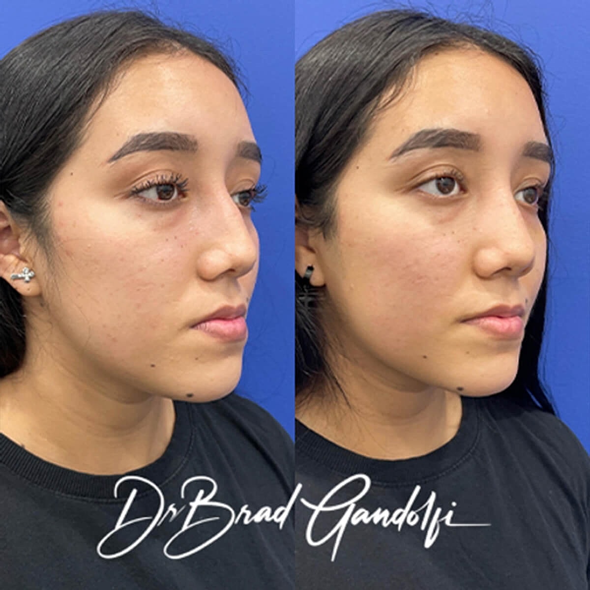 Rhinoplasty Before & After