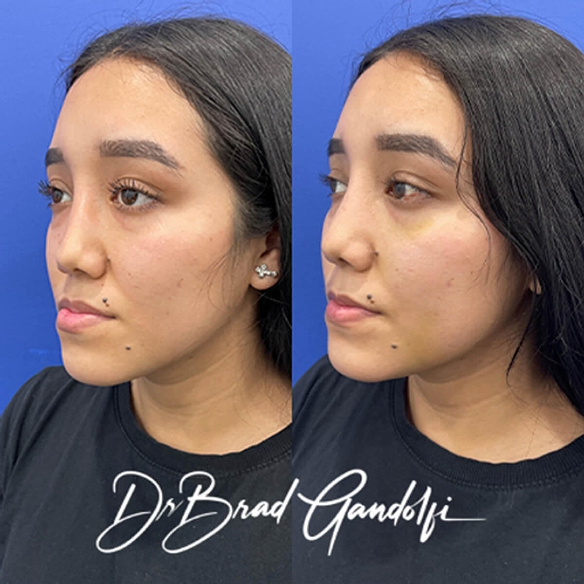 Rhinoplasty Before & After