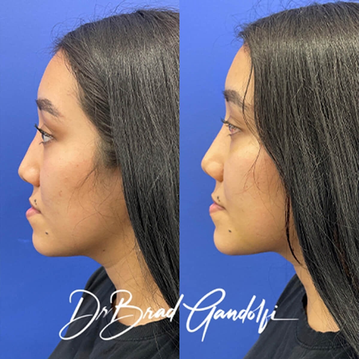 Rhinoplasty Before & After