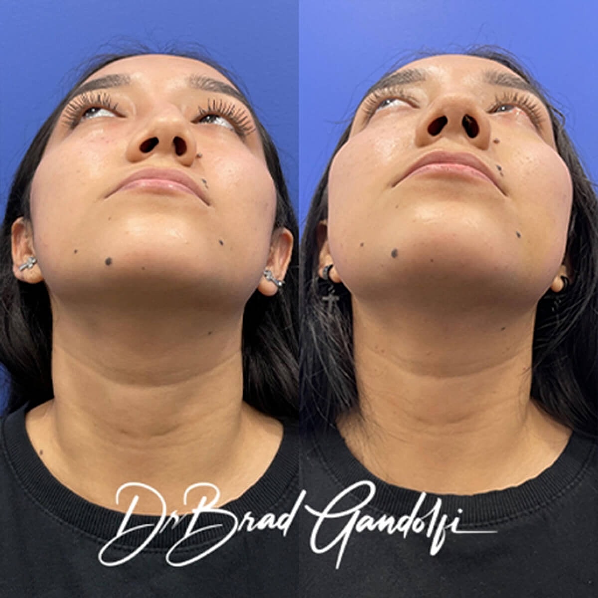 Rhinoplasty Before & After