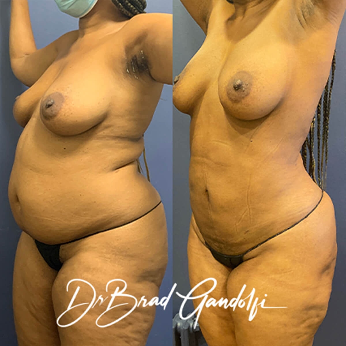 Liposuction Before & After