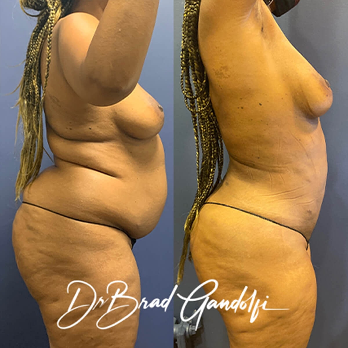 Liposuction Before & After