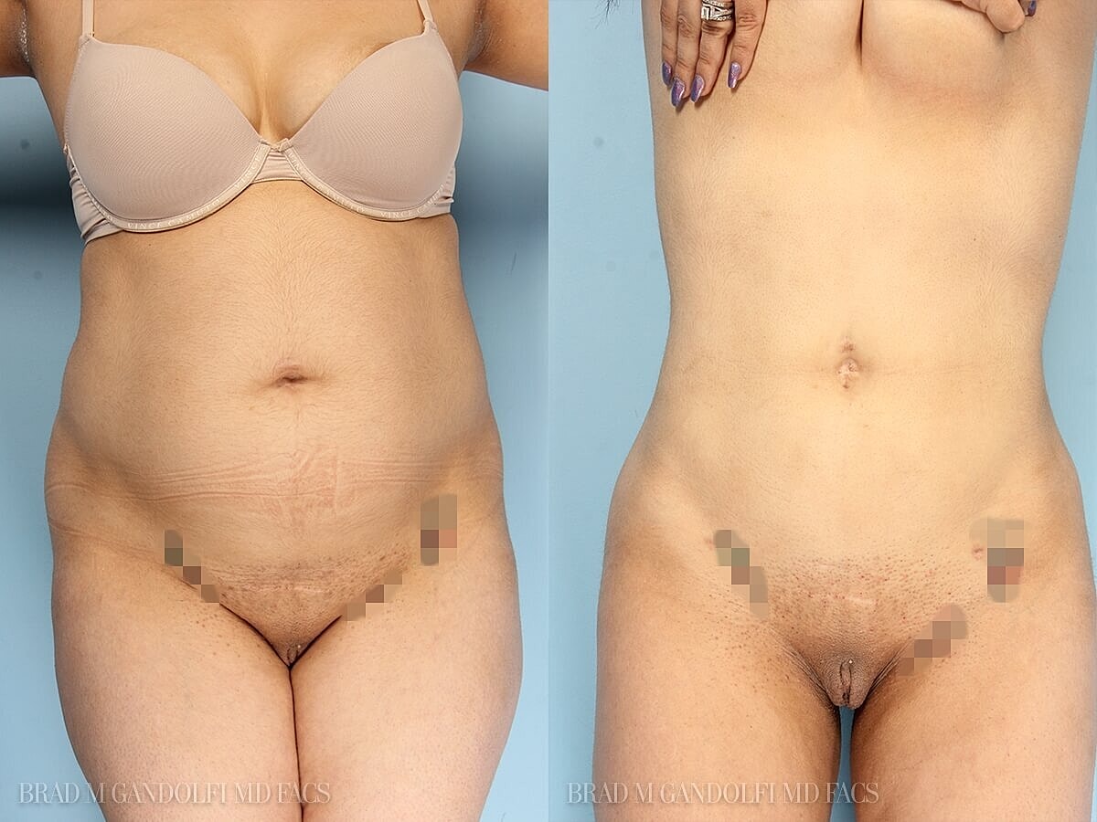 Liposuction Before & After
