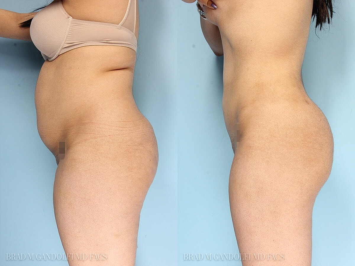 Liposuction Before & After
