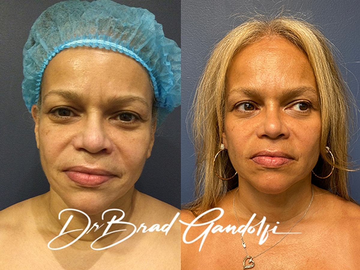 Facelift Before & After